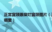 正常宫颈跟糜烂宫颈图片（正常宫颈图和宫颈糜烂的区别在哪里）