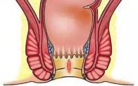 包头东大肛肠医院详解：肛裂为何反反复复，经久不愈？