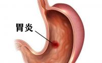 佛山肛泰肛肠医院：经常感觉胃胀、消化不良？什么原因引起的？