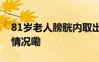 81岁老人膀胱内取出300多颗结石 到底什么情况嘞